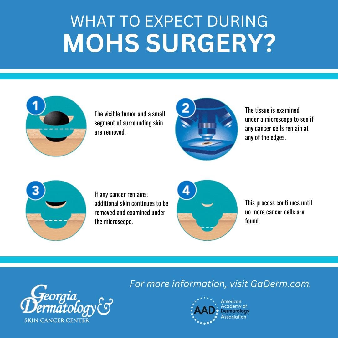 Mohs surgery is a highly effective advanced technique for the treatment of skin cancer that provides the patients with quick resolution, rapid recovery, and peace of mind. It is considered the &ldquo;Gold Standard&rdquo; because it offers the highest