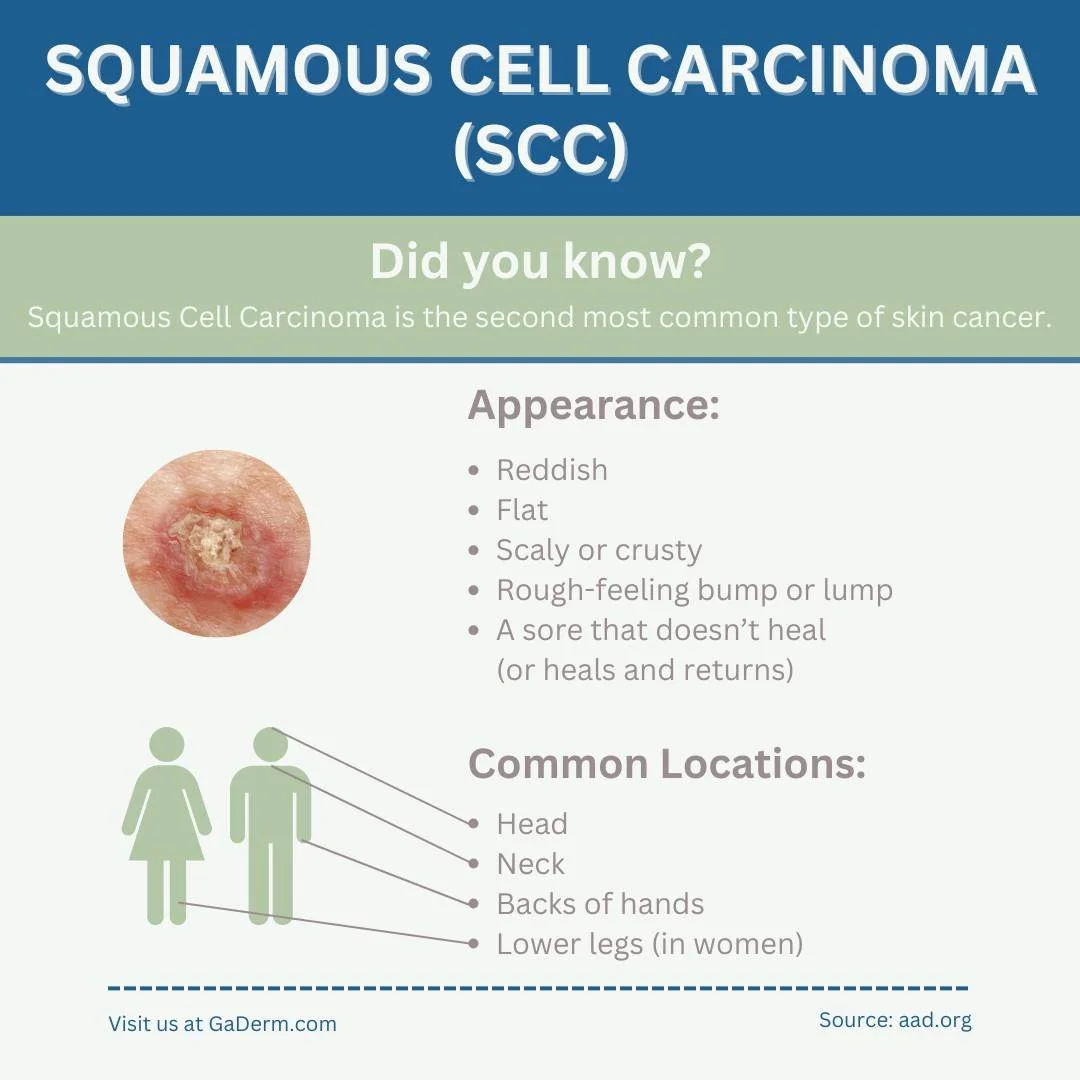 Did you know?

Squamous cell carcinoma (SCC) of the skin is the second most common form of skin cancer, characterized by abnormal, accelerated growth of squamous cells. SCCs can appear as scaly red patches, open sores, rough, thickened or wart-like s