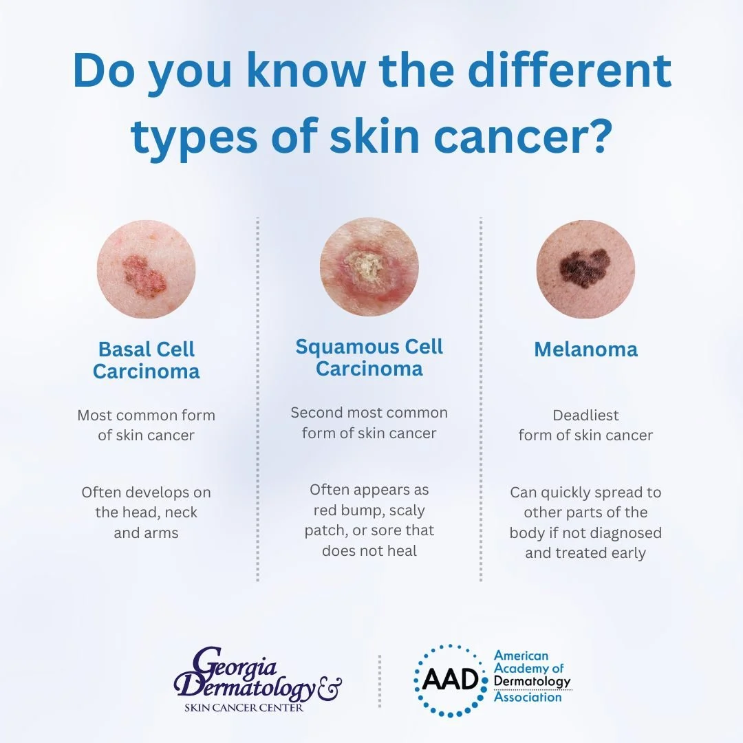 Do you know the different types of skin cancer?

- Basal Cell carcinoma is the most common form of skin cancer.

- Squamous cell carcinoma often appears as red bump, scaly patch, or sore that doesn't heal.

- Melanoma is the deadliest form of skin ca