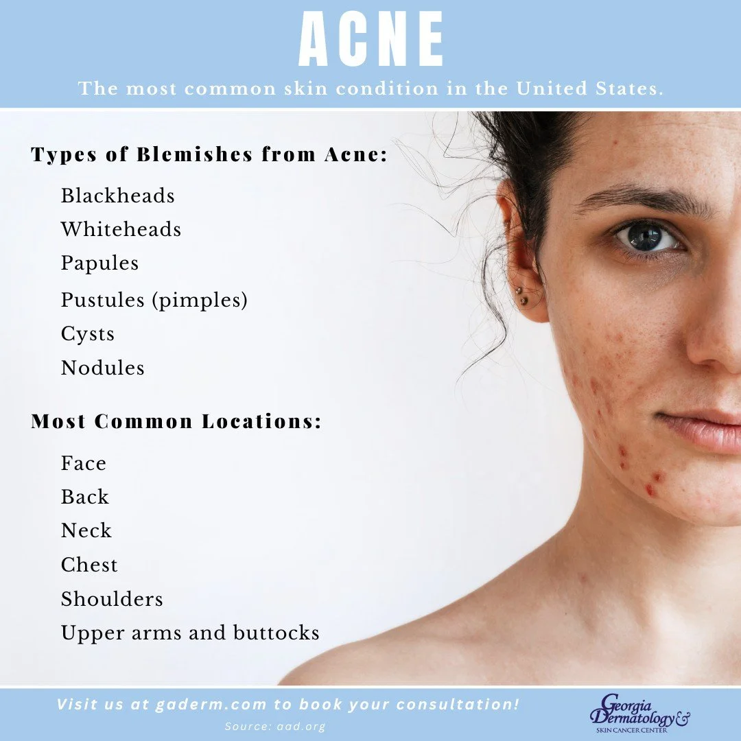 Acne is the most common skin condition in the United States. People of any age and race struggle with this skin condition. The location of acne can vary, but most commonly appears on the face, neck, chest, back, shoulders, and upper arms and buttocks