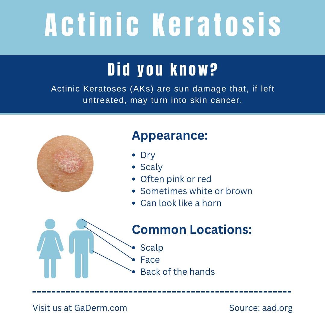 Actinic Keratoses (AKs) are sun damage that, if left untreated, may turn into skin cancer.

Often appearing as dry, scaly red patches on your skin, AKs sometimes appear as white or brown and can look like a horn. You may notice them most commonly on 
