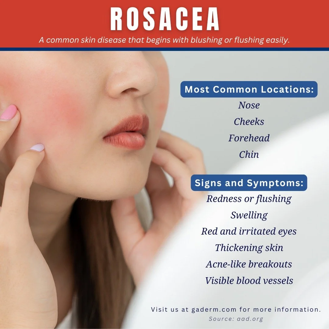 Rosacea is a common skin condition that causes blushing or flushing and visible blood vessels in your face. It may also produce small, pus-filled bumps. These signs and symptoms may flare up for weeks to months and then go away for a while. There's n