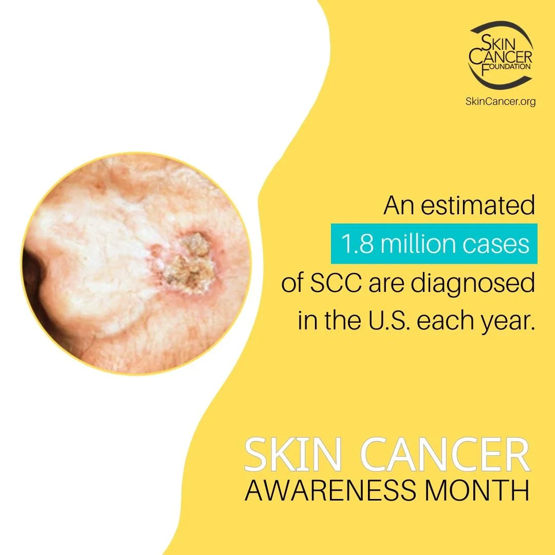 Did You Know?

SCC occurs when DNA damage from exposure to ultraviolet radiation or other damaging agents trigger abnormal changes in the squamous cells.

#GaDerm #SkinCancerAwarenessMonth #ThisIsSkinCancer #SharetheFacts #SkinCheckChallenge