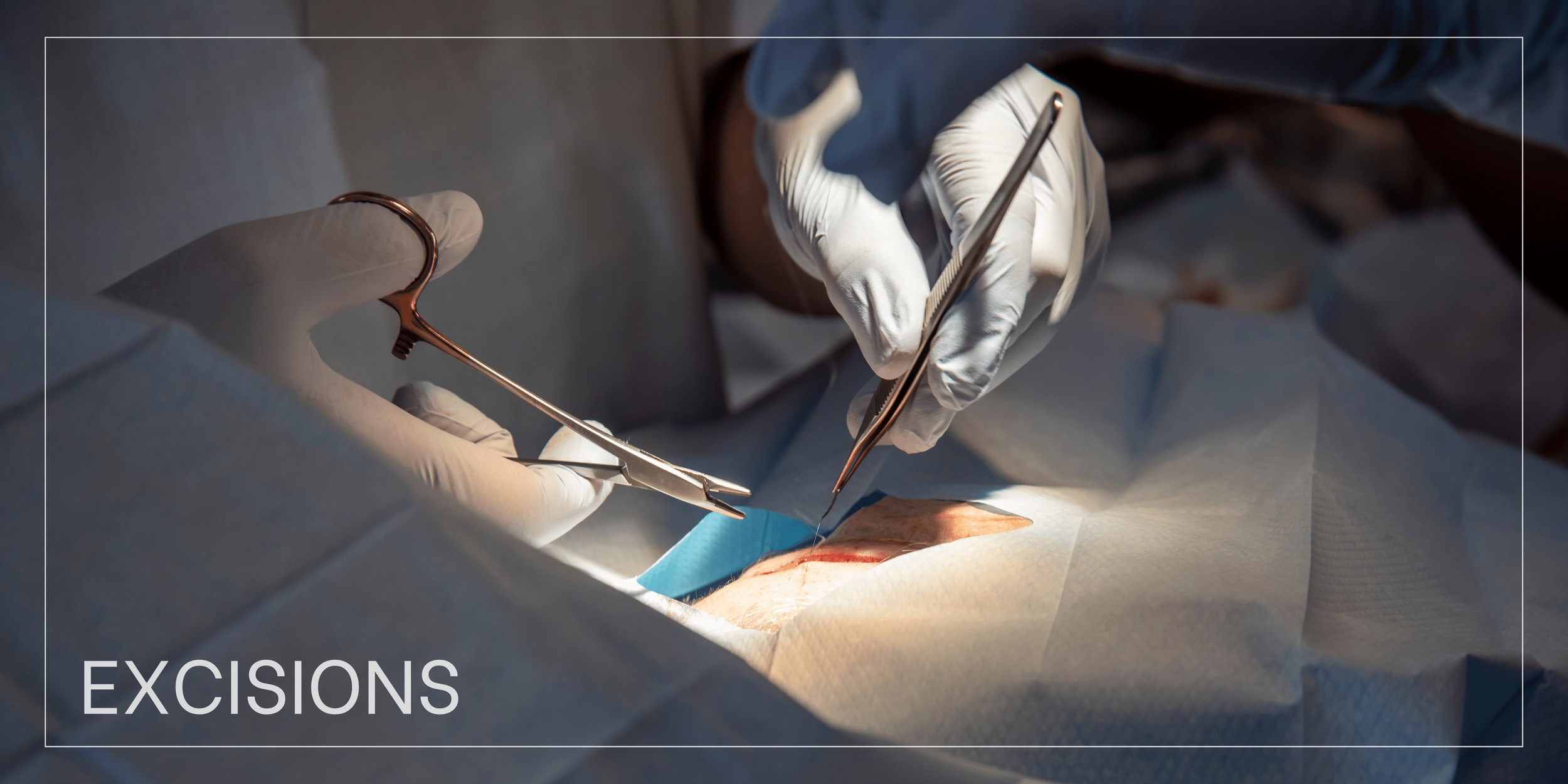 Excisions — Georgia Dermatology & Skin Cancer Center