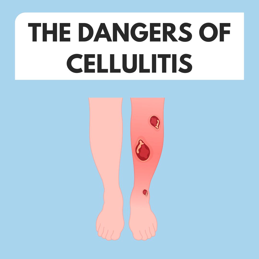 The Dangers of Cellulitis