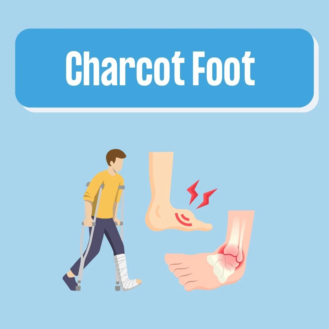 Charcot Foot