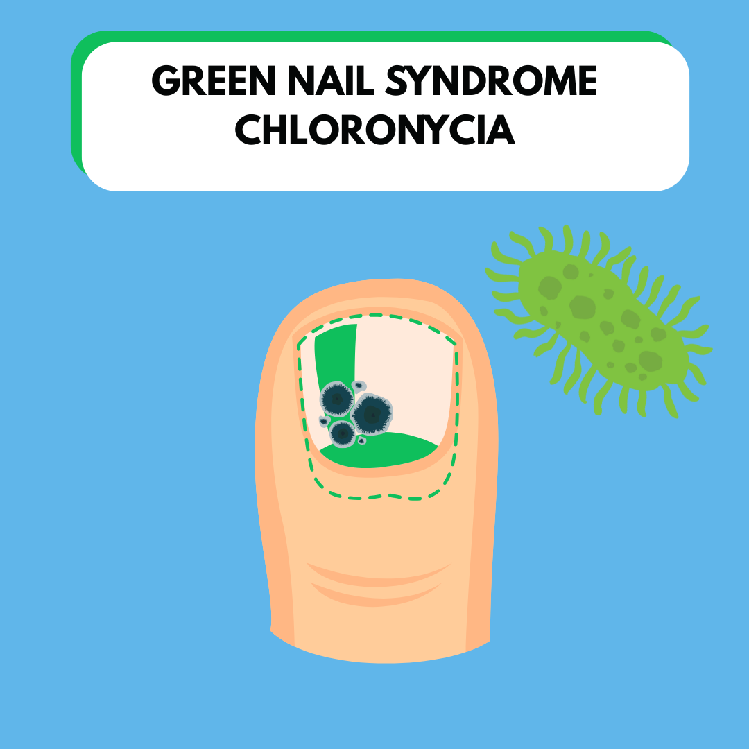 Green Nail Syndrome