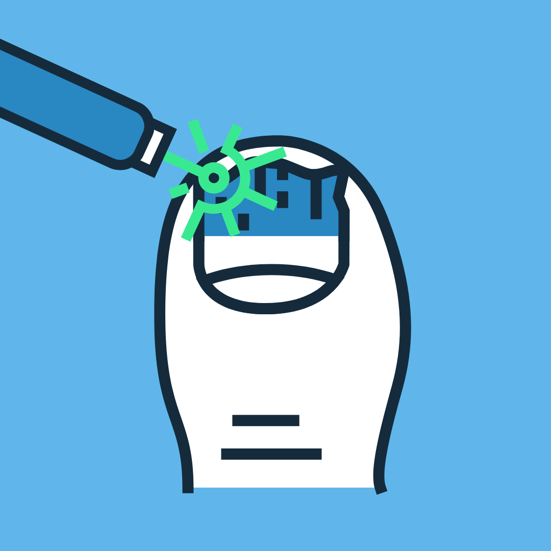 Fungal Nail Laser Therapy — Relief Podiatry