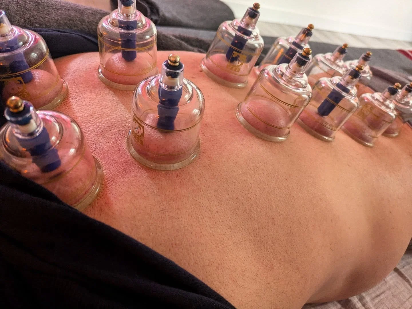 👉🏼✨ Shiatsu et Ventouses.
.
.
.
👉 Contactez-moi pour plus d'informations et pour prendre rendez-vous 😉

Ou visitez mon site davideshiatsu.com
.
.
.
#cupping 
#ventouses 
#shiatsuparis