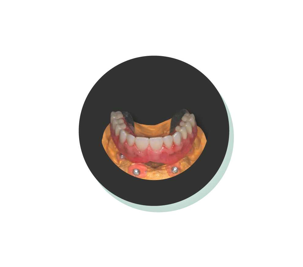 Hybrid Dentures with ERA Attachments