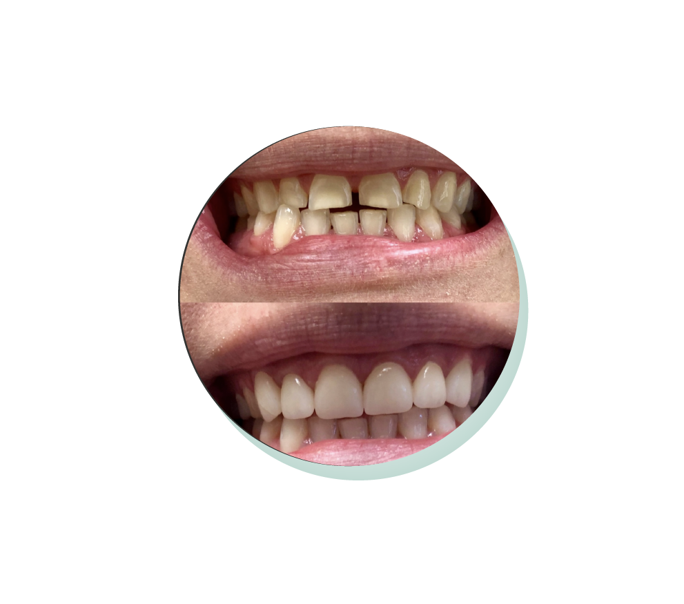 Emax Veneer Makeover