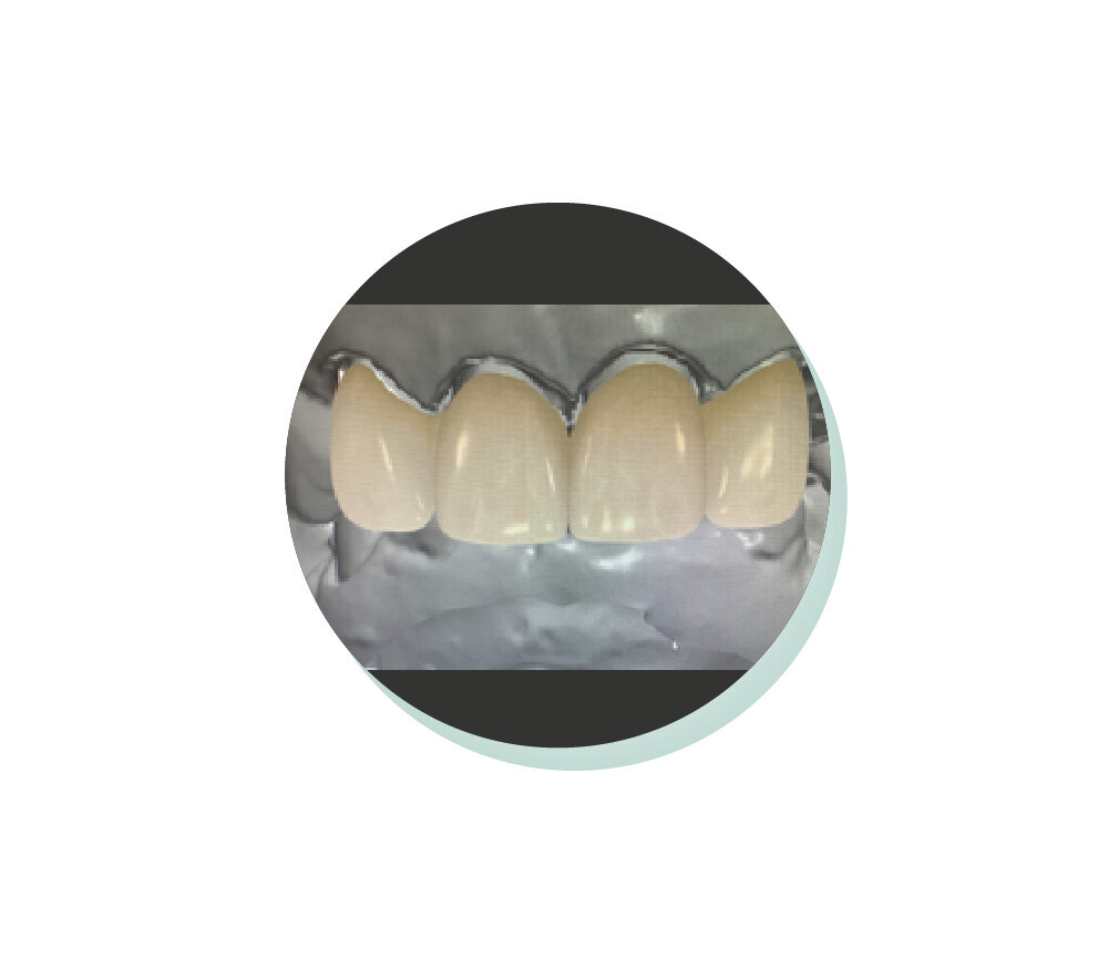 Anterior Zirconia Crowns