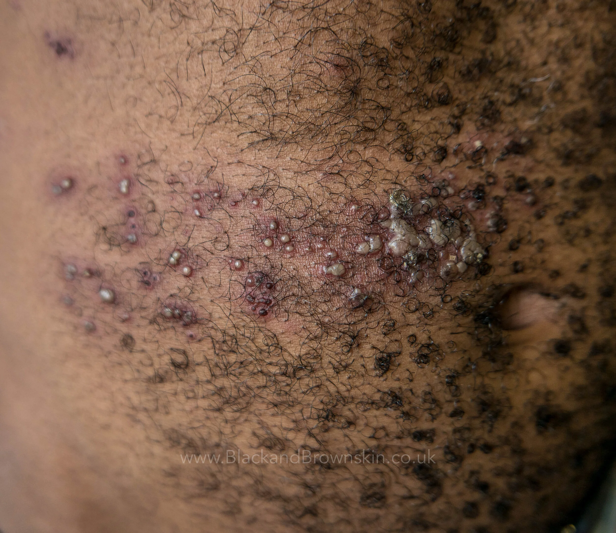 P1040684-217medical, Shingles.jpg