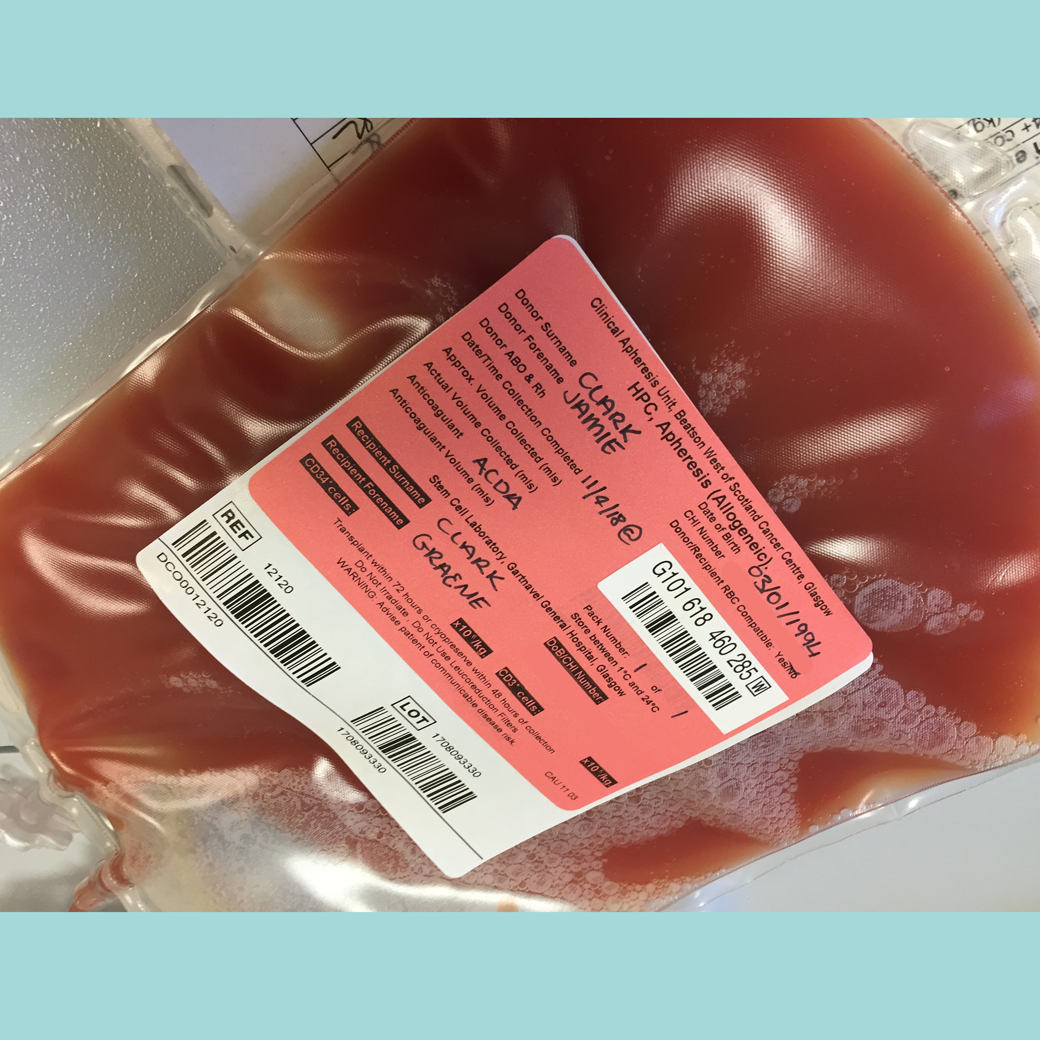 Bag of donated stem cells