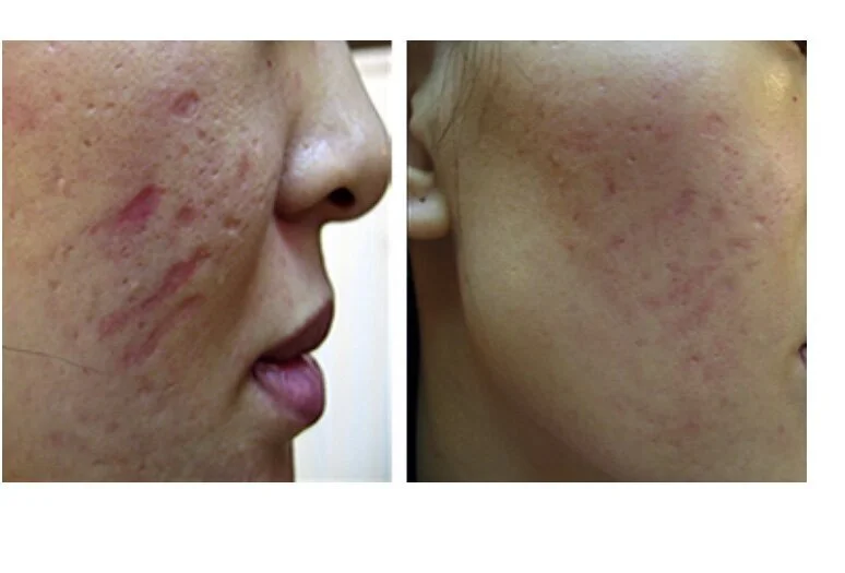 Microneedling+before+and+after+2.jpeg