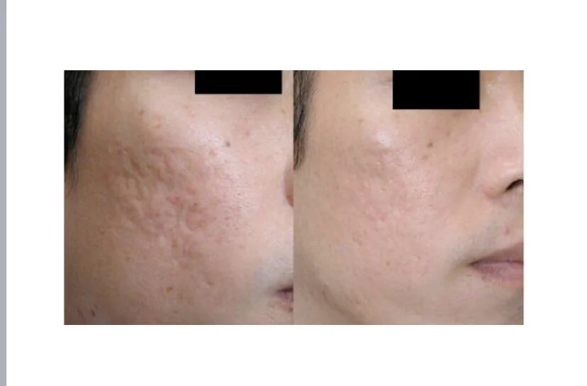 Microneedling+before+and+after.jpeg