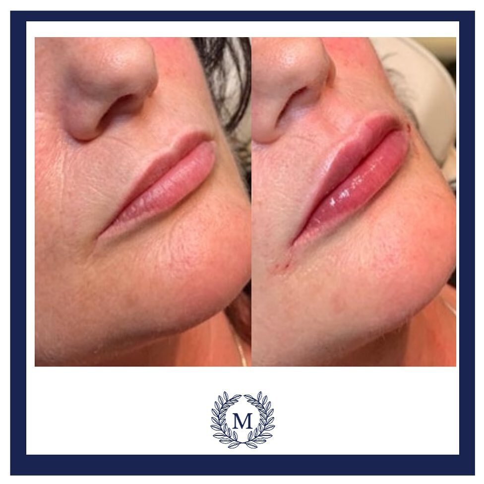 We adore the result from this &ldquo;tweakment&rdquo;. The lips look refreshed and hydrated giving a really youthful appearance which in no way looks filled. 

Subtlety is always the way and something that Dr Raph promoted to all patients of all ages