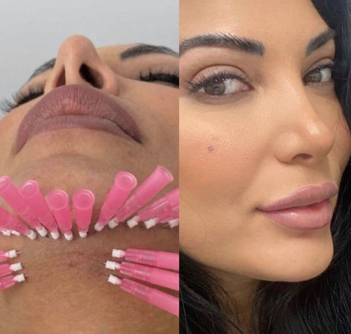 PDO Mono Thread Treatment Brisbane | Sonder Private Clinic