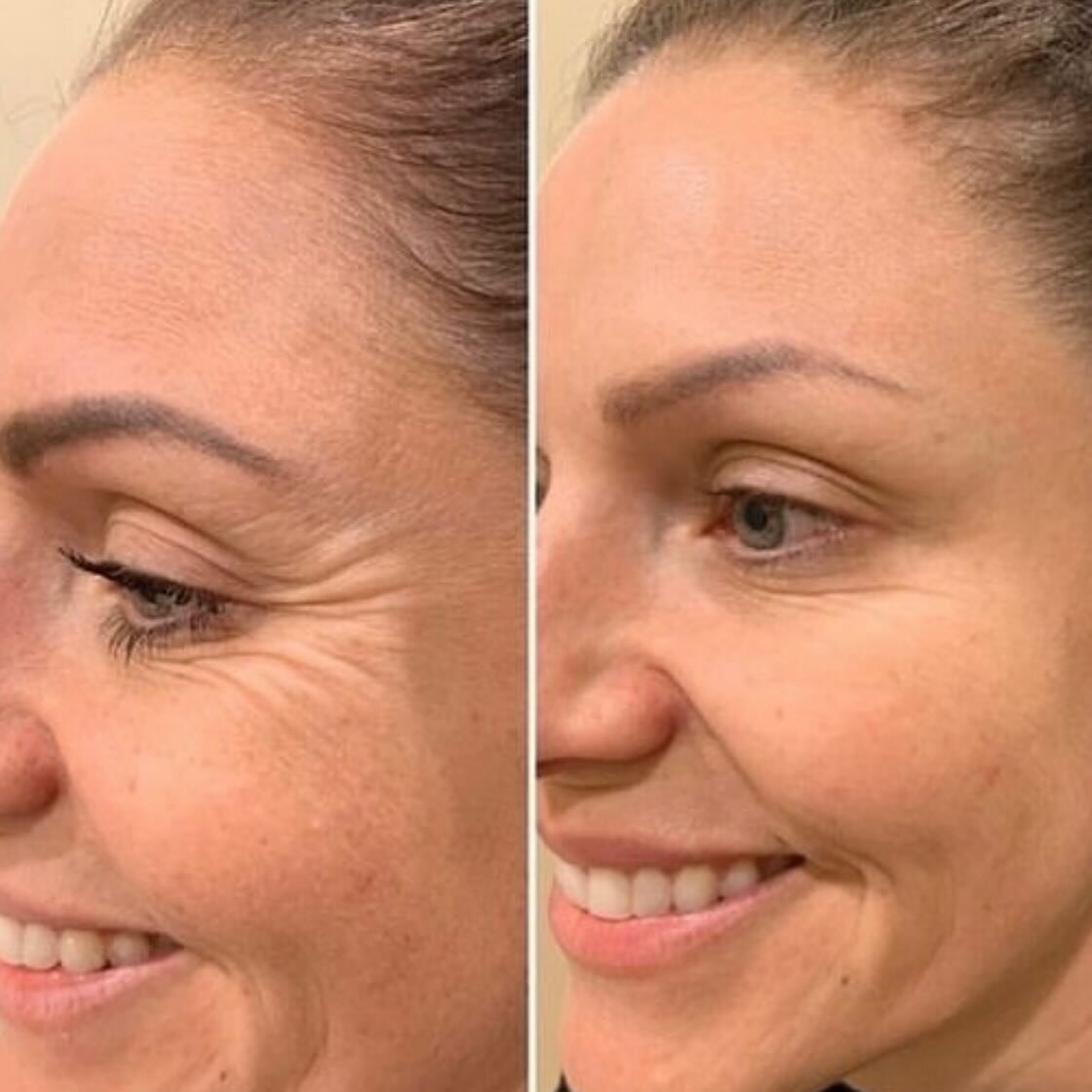 PDO Mono Thread Treatment Brisbane Sonder Private Clinic