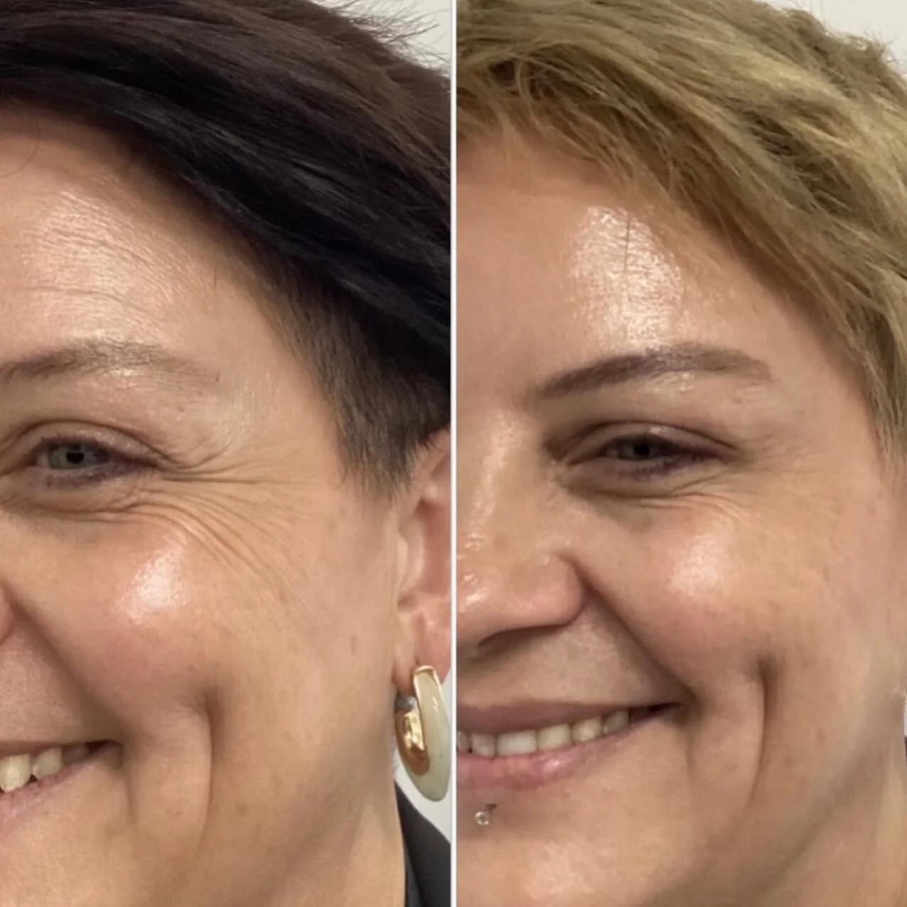 IV Vitamin Therapy Vitamin Infusion Treatment Brisbane Sonder