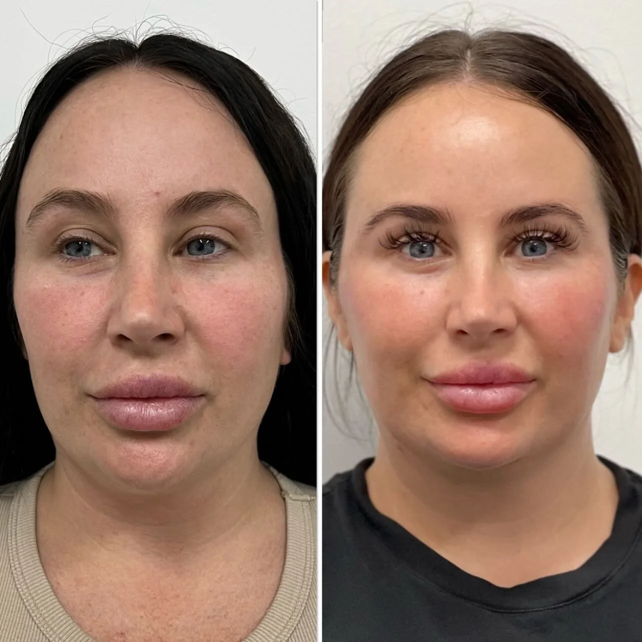 PDO Mono Thread Treatment Brisbane Sonder Private Clinic