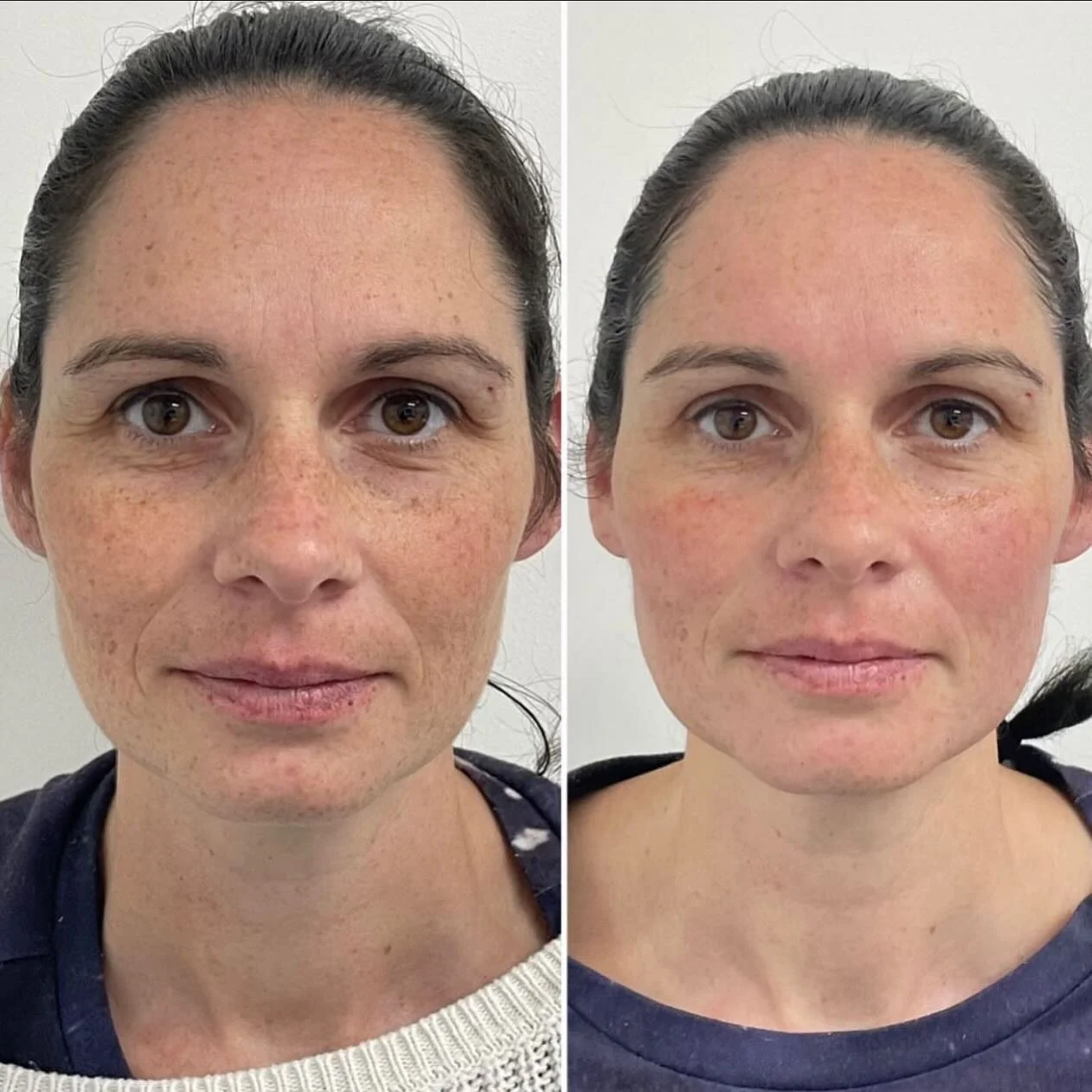 PDO Mono Thread Treatment Brisbane Sonder Private Clinic