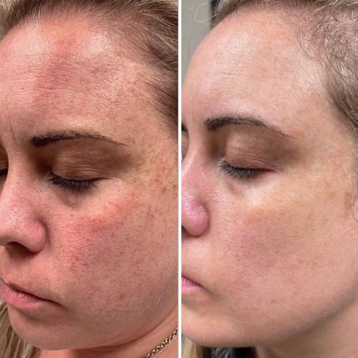 PDO Mono Thread Treatment Brisbane Sonder Private Clinic