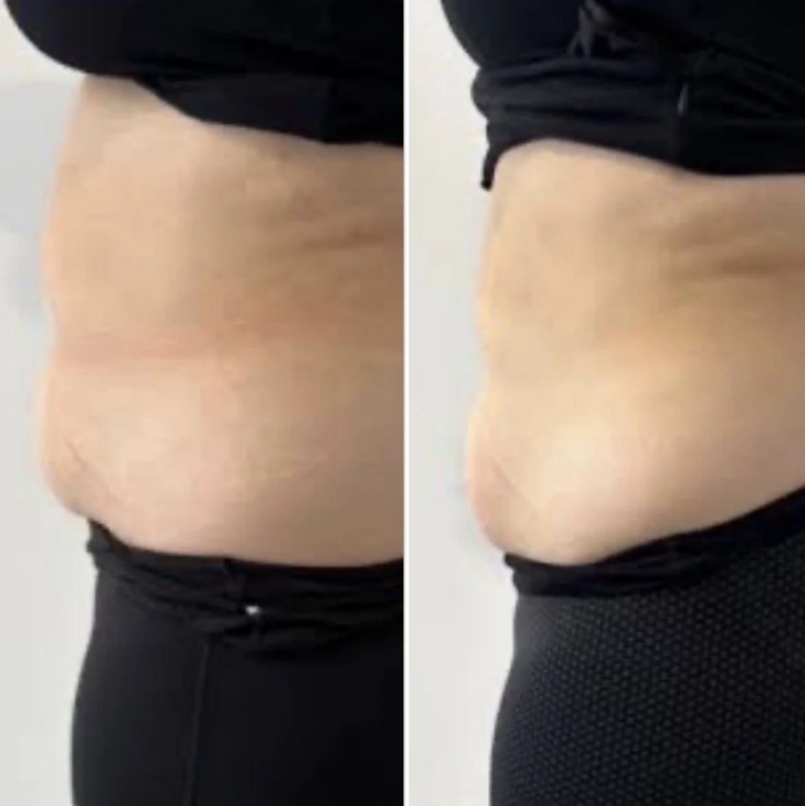 Stomach Body Sculpting