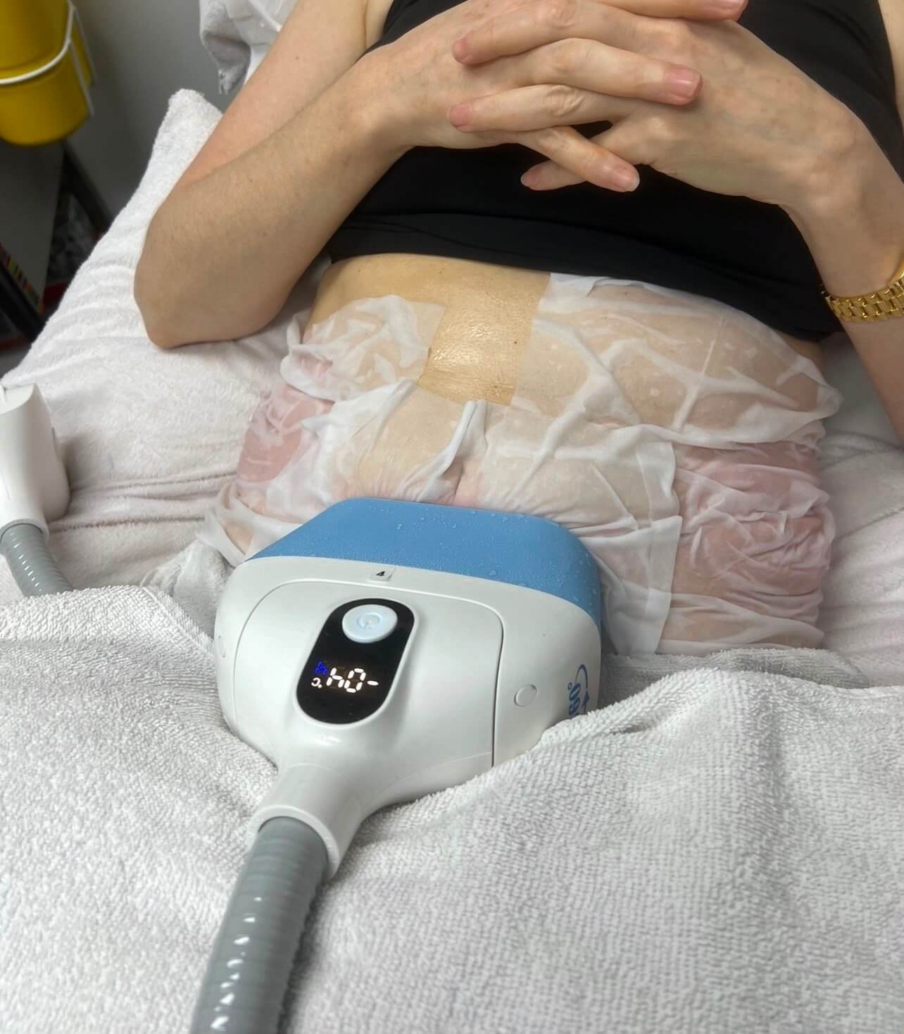 Fat freezing treatment at Sonder Private Clinic