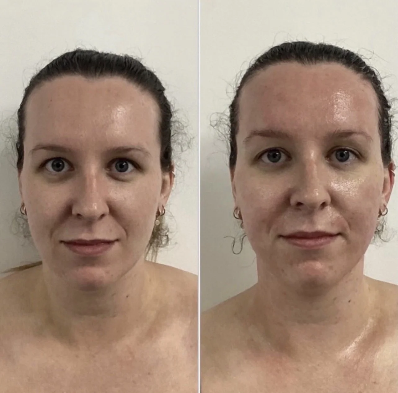 HIFU FaceLift- A high intensity focused ultrasound facial