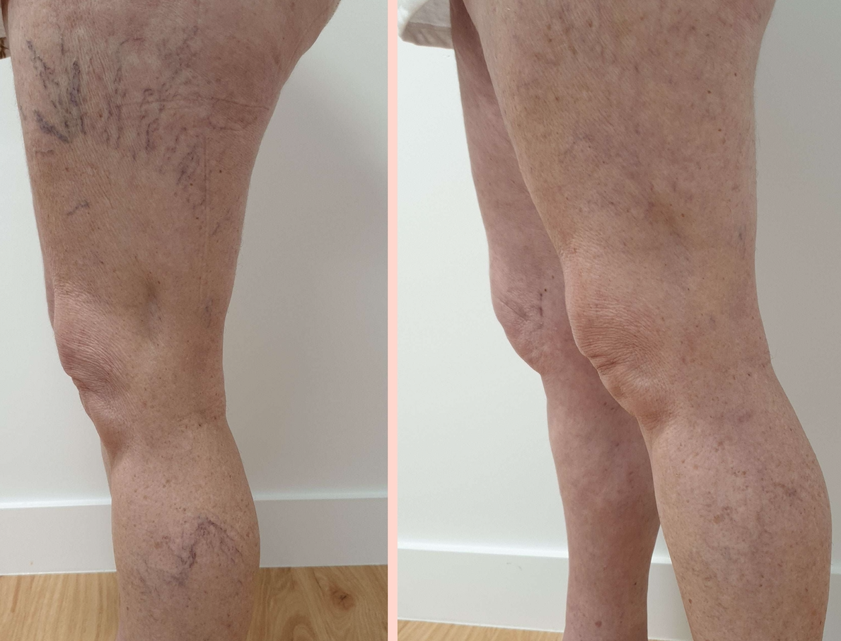 Sclerotherapy Brisbane Sonder Private Clinic