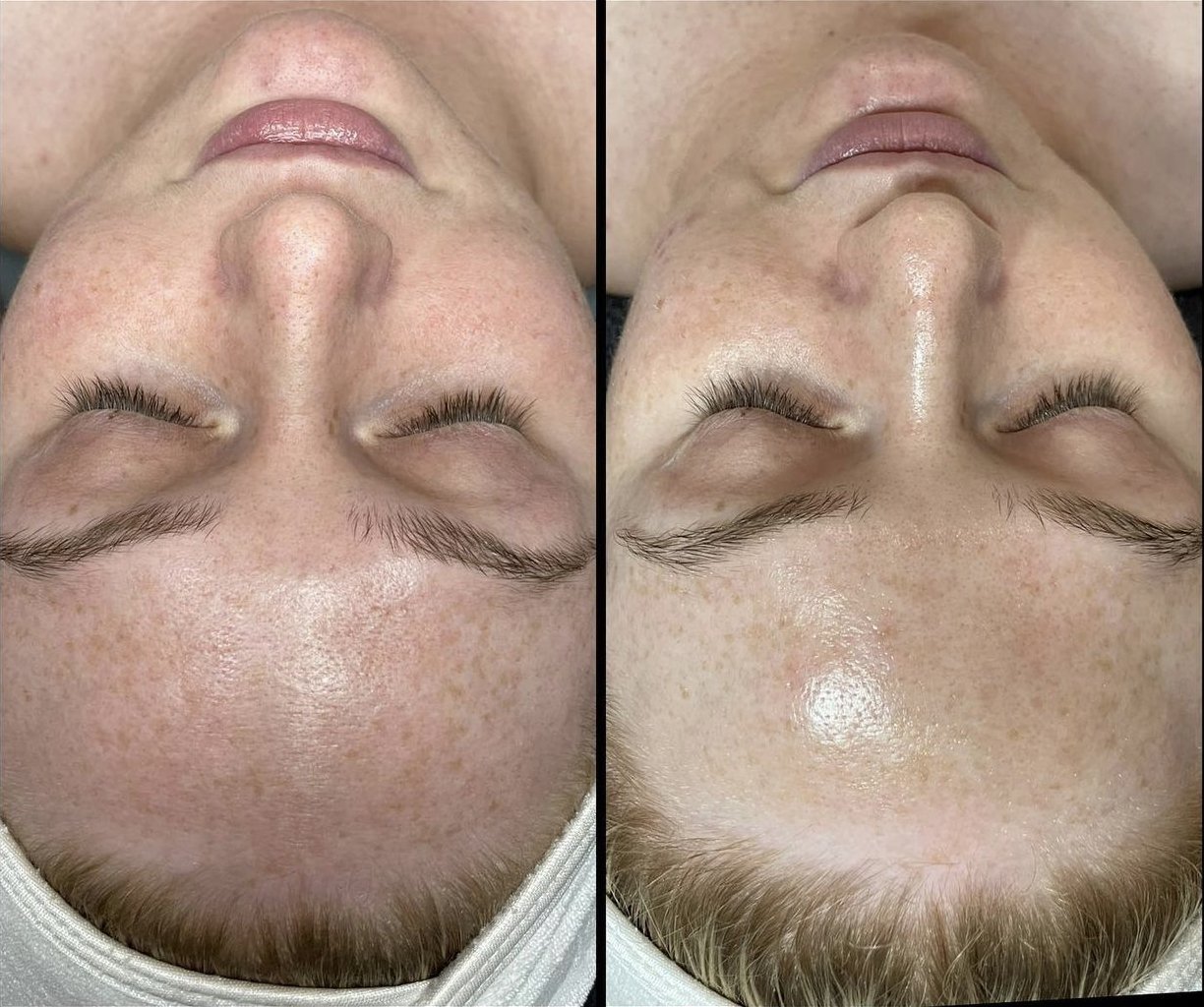 AlumierChemicalPeel.jpg