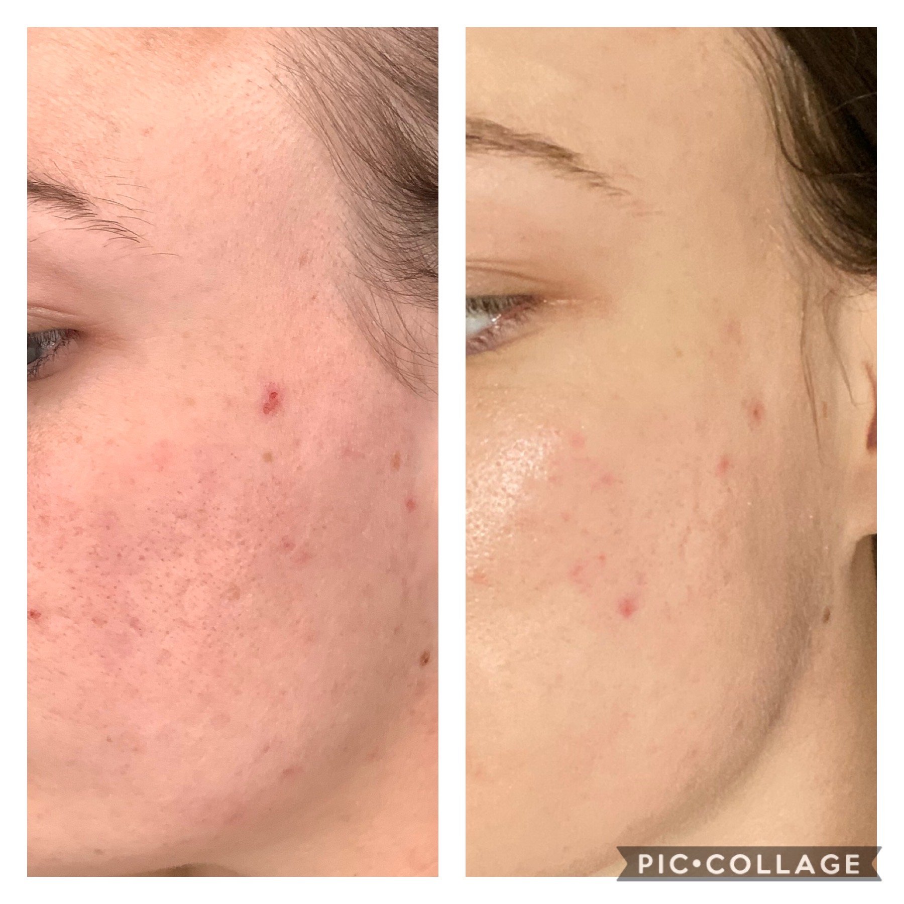 Microneedling1.JPG