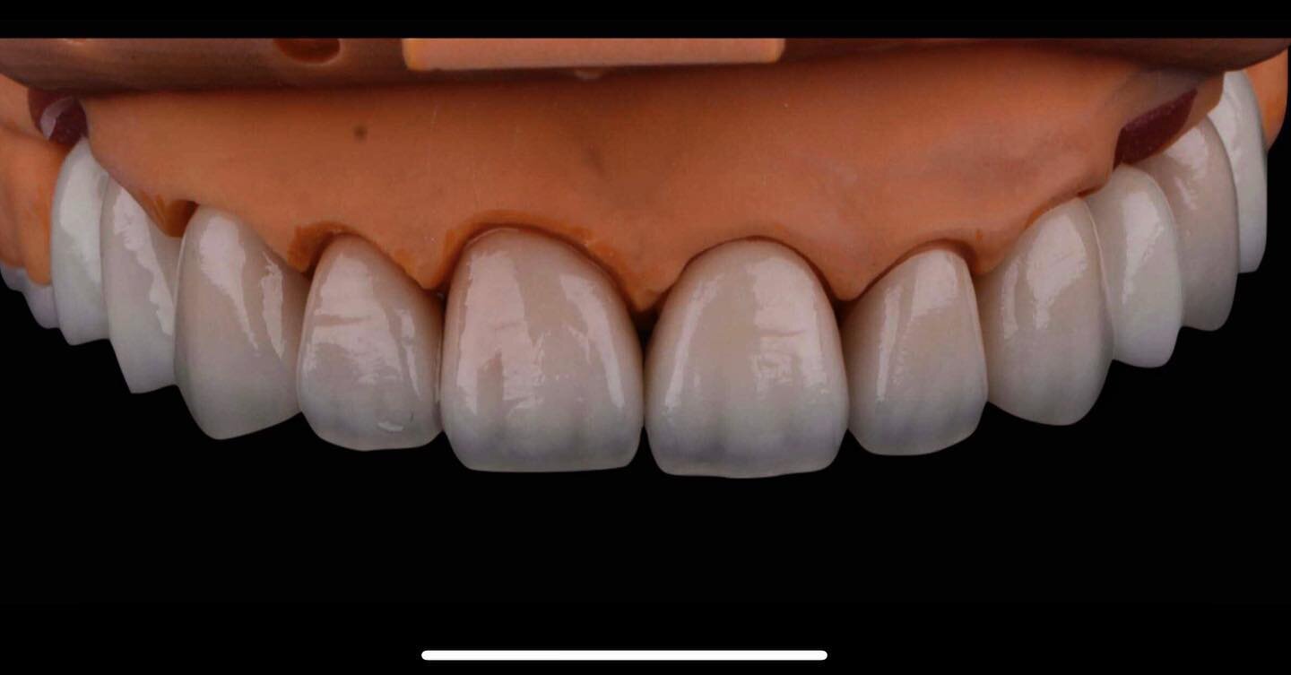 eMax Porcelain full mouth restorative.
.
.
.
.
#emaxceram #smilemore #dentistsofinstagram #dentallaboratory #dentaltechnicians #porcelain #odontologista #synergy3d #dentaloffice #dentalassistantlife #dentalassistants #dentalart