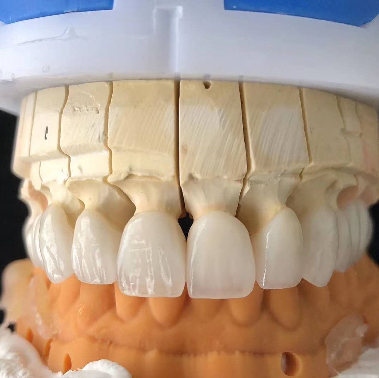 eMax .
.
.
.
.
#dentallab #dentalhygiene #teethgoals #emaxcrowns #ceramicteeth #translucent #ivoclarvivandet #c14 #fullmouthrehabilitation