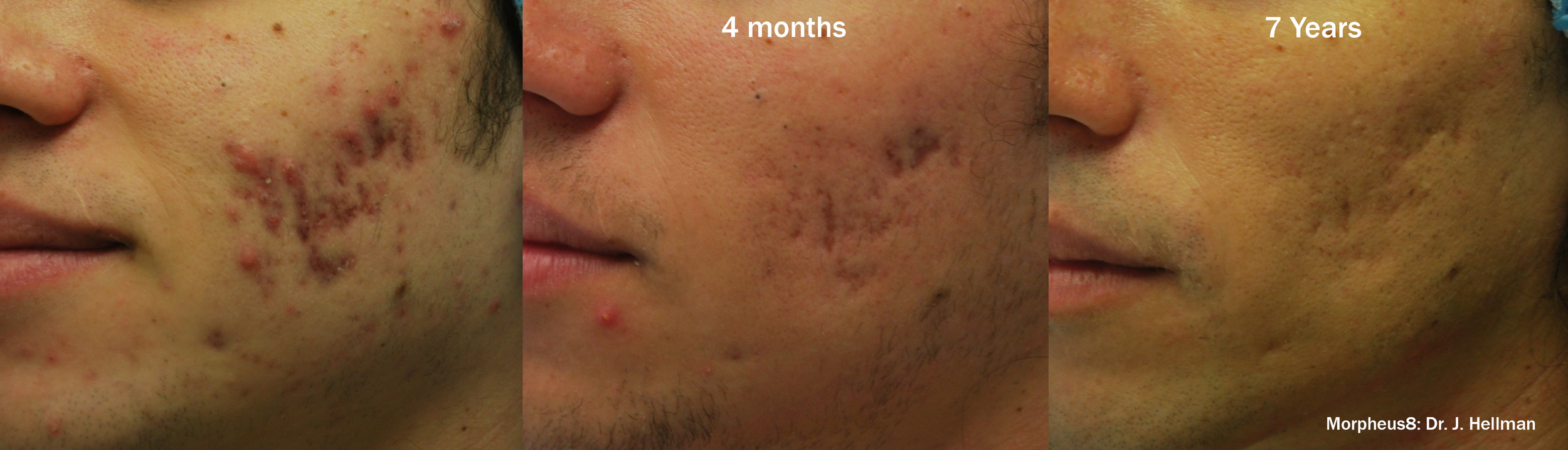 morpheus8-before-after-dr-j-hellman-preview-5.png