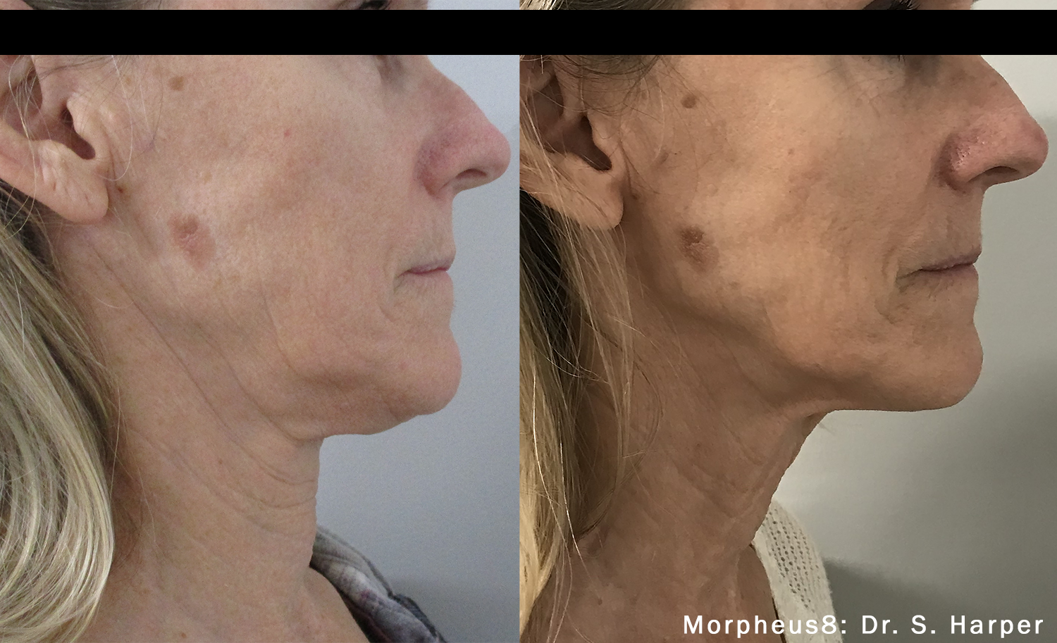 morpheus8-before-after-dr-s-harper-preview-3.png