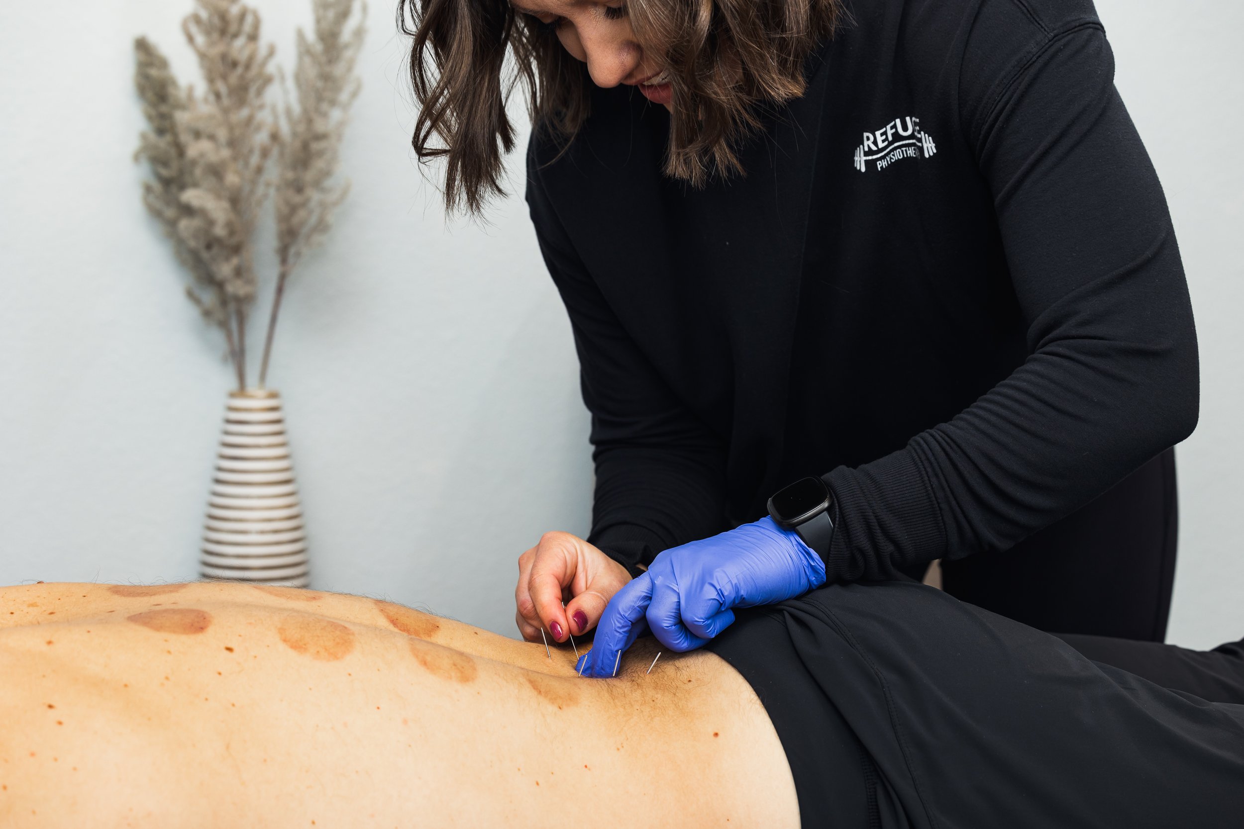 Dry Needling…What’s the Hype About?