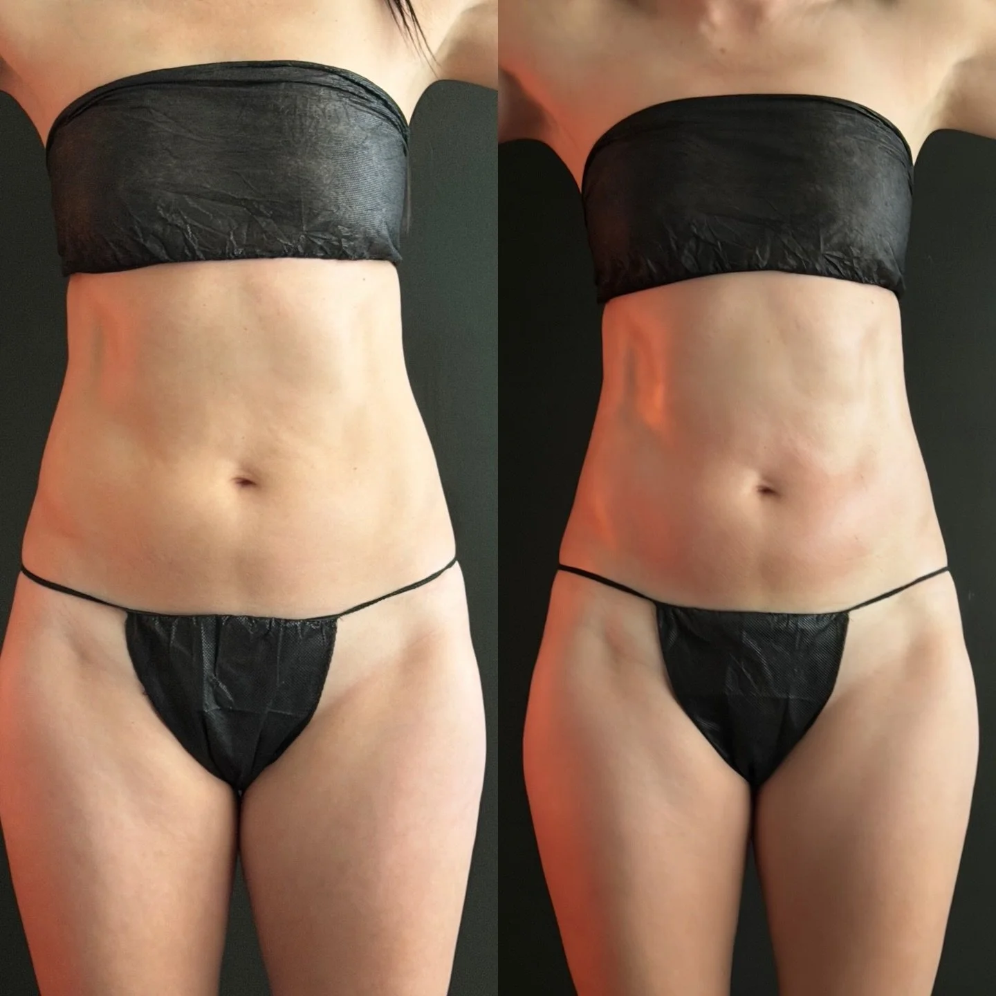 sculpted contours. 
more definition, detox pathways flowing, increased energy and no more fluid stagnation. 🤍

client booked in for THE FULL TORSO CONTOUR and for her treatment plan we did:
&bull;brazilian lymphatic 
&bull;cavitation
&bull;vacuum th