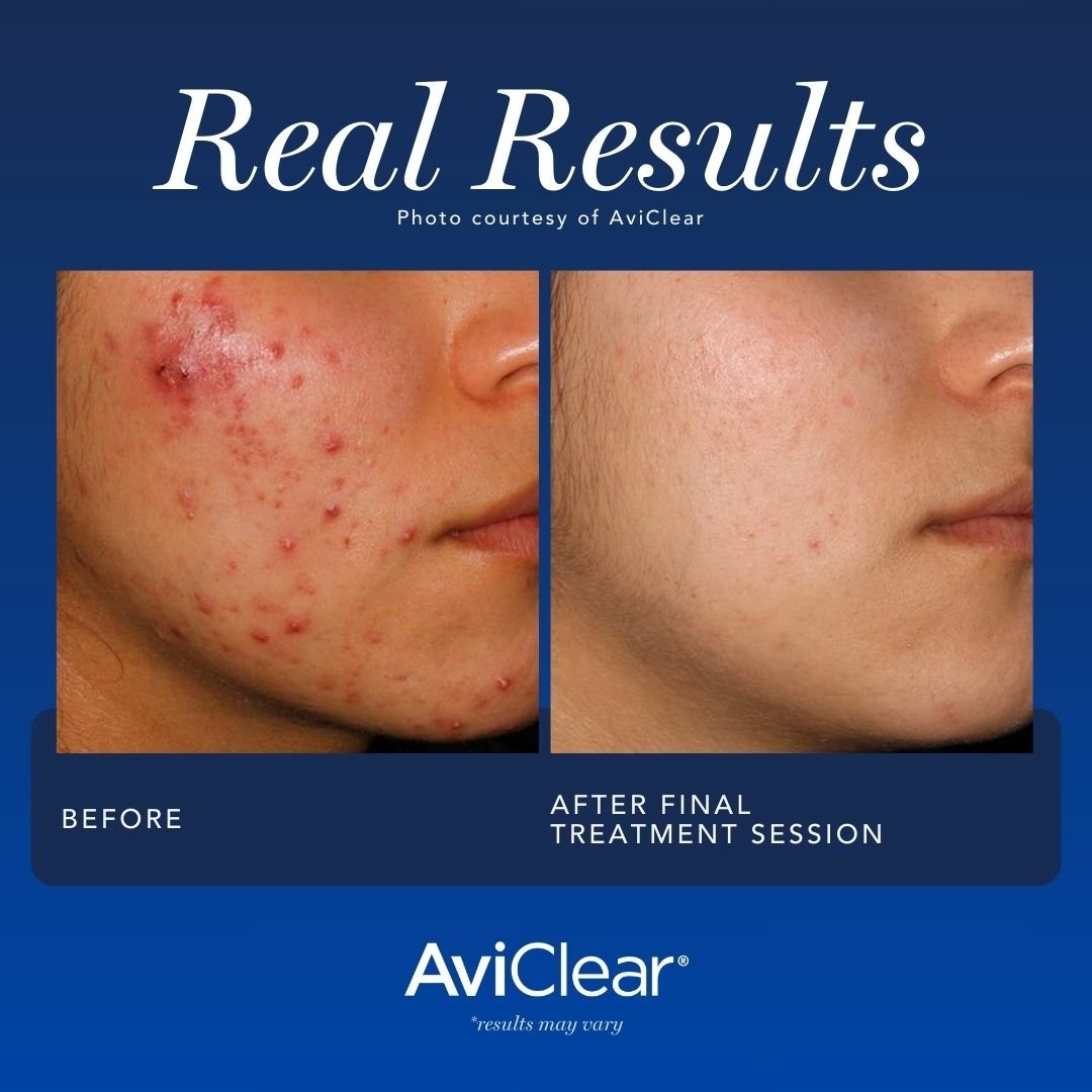 Aviclear Before After 04.jpg