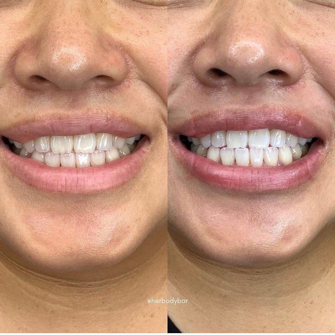 When you smile, the world stops and stares for a while . . . because you&rsquo;re beautiful! ✨
⠀⠀⠀⠀⠀⠀⠀⠀⠀
Teeth whitening is on sale this week only! Click the link in the bio to save on Her Body Bar teeth whitening services
⠀⠀⠀⠀⠀⠀⠀⠀⠀
⠀⠀⠀⠀⠀⠀⠀⠀⠀
#herbod
