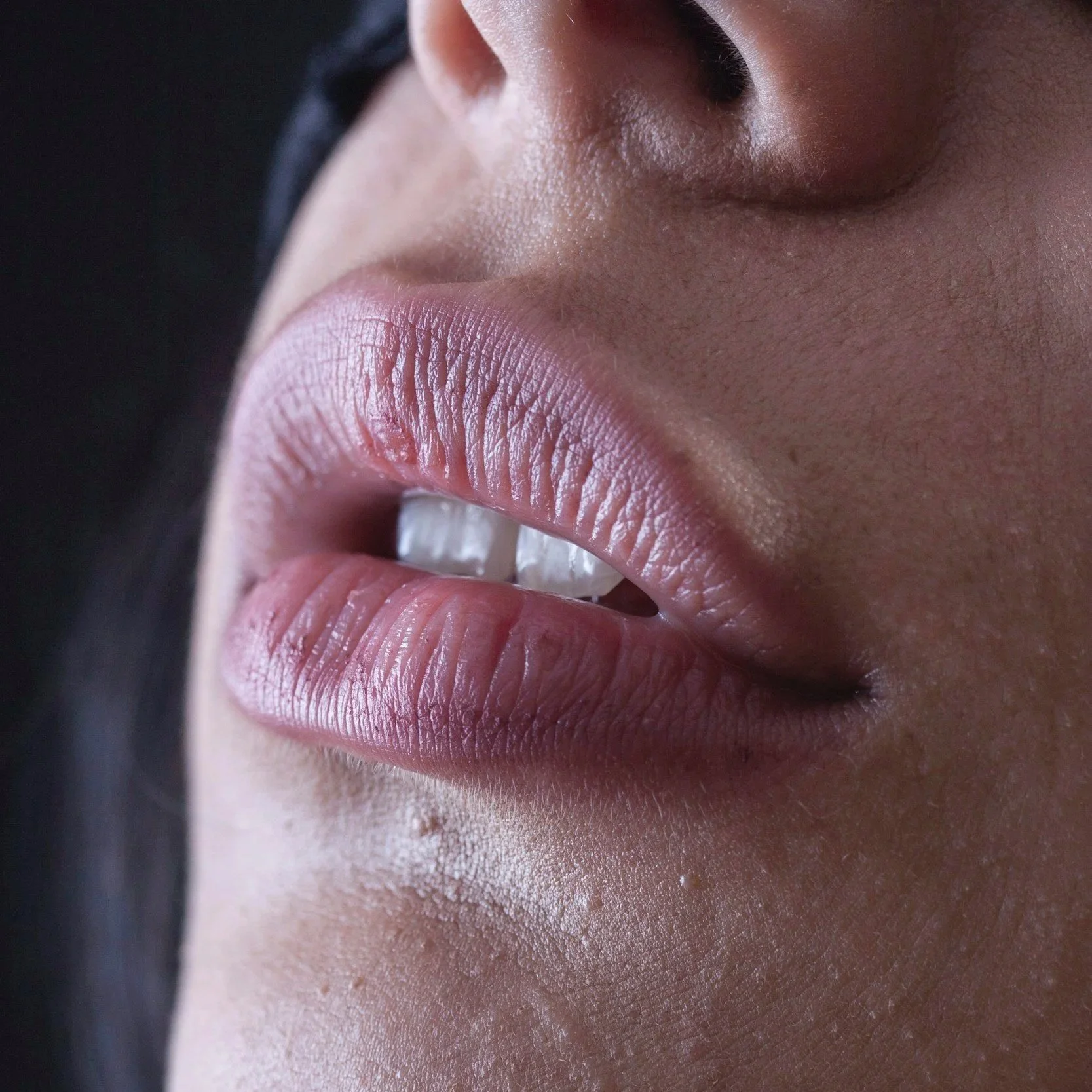 LIP LIFT
