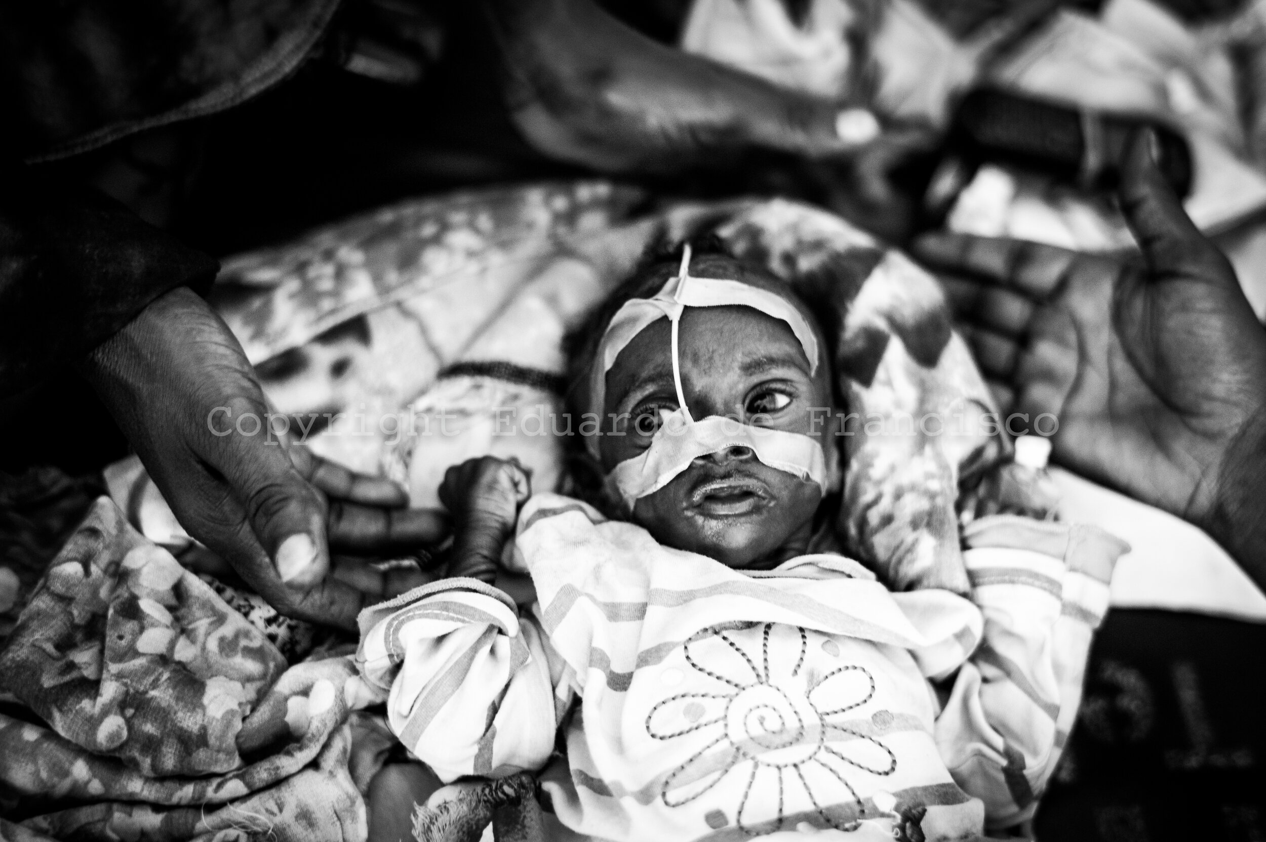  Ifrah Mukhtar, who is three months old and weights 2.3 kg. Born in Afgoye, her mother and grandmother brought her to Mogadishu in order to receive malnutrition treatment. They arrived with nowhere to sleep or money to buy food, so the hospital feeds