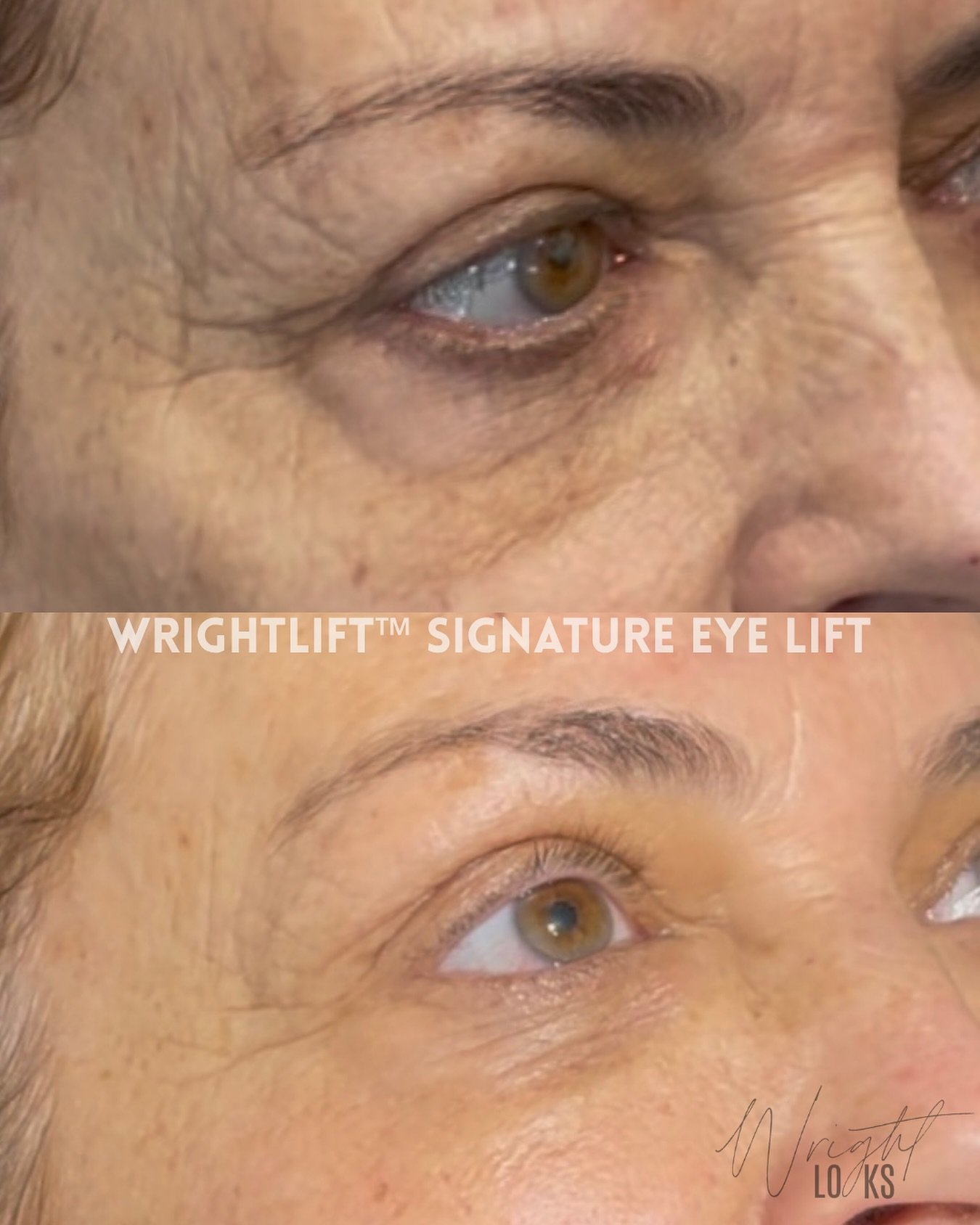 She didn&rsquo;t need Botox &mdash; she needed the WrightLift&trade;.
 💫 No needles. No downtime. 
💫 Just lifted lids, tighter under-eyes, and softened fine lines &mdash; all in one session!

✨ The WrightLift&trade; Signature Eye Lift combines Fibr