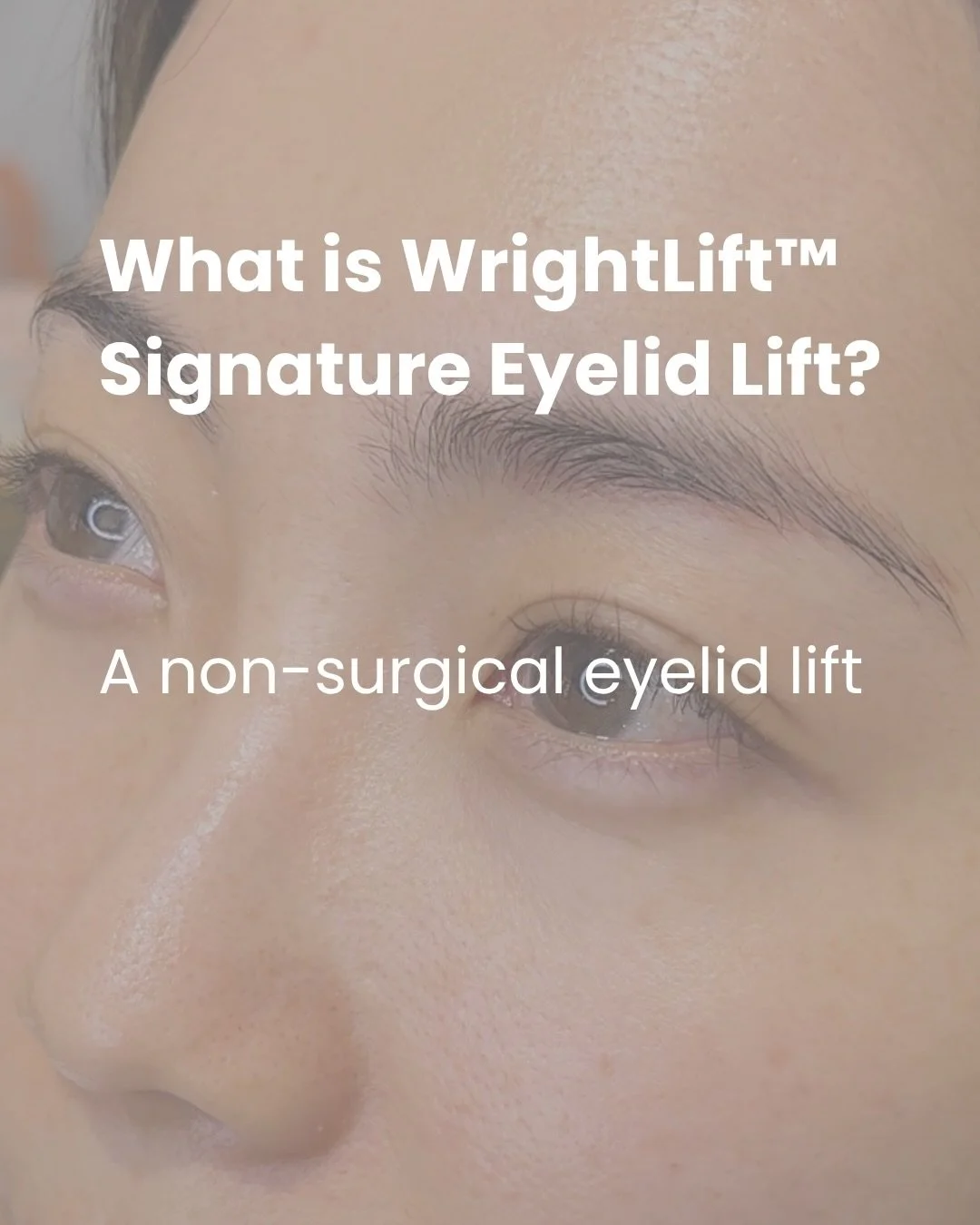 What is WrightLift&trade; Signature Eyelid Lift?

WrightLift&trade; is our signature Fibroblast Skin Tightening treatment at WrightLooks. The Signature Eyelid Lift targets the upper lids, lower lids, and crow&rsquo;s feet for a non-surgical approach 