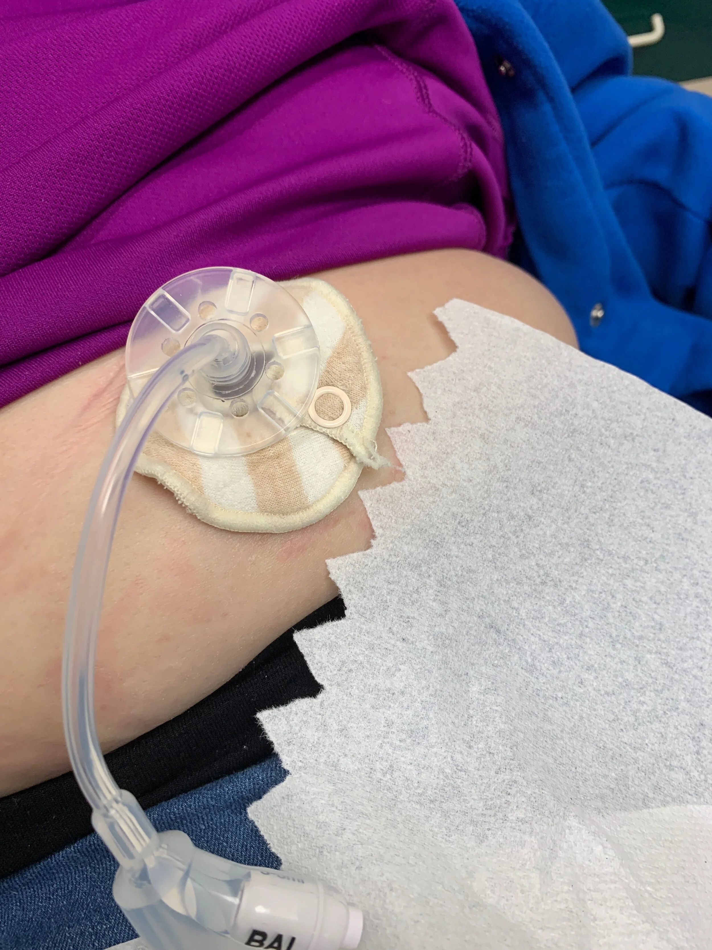 G-tube pad to absorb fluids and protect your skin. These replace gauze, are washable, and are available online. Please click the photo above to take a look at some g-tube pads we recommend.