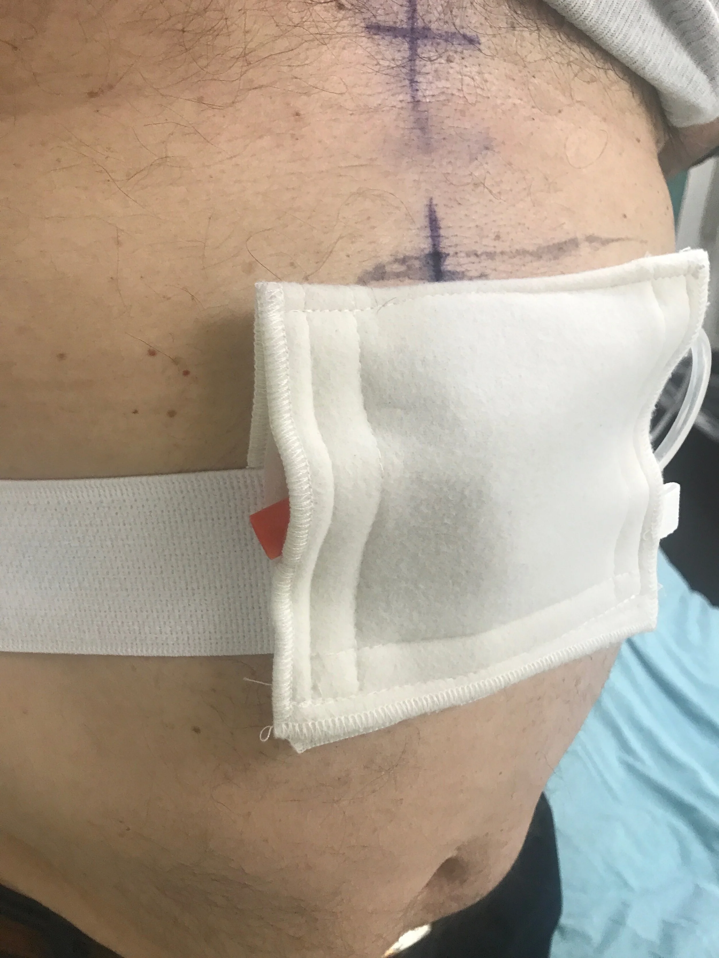 G-tube belt pouch with hoop-loop closure to secure g-tube and help prevent accidental dislodgment.
These are available online; please click the photo above to check out a g-tube pouch we recommend.