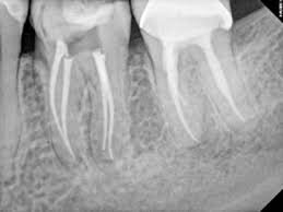 root canal tooth.jpg