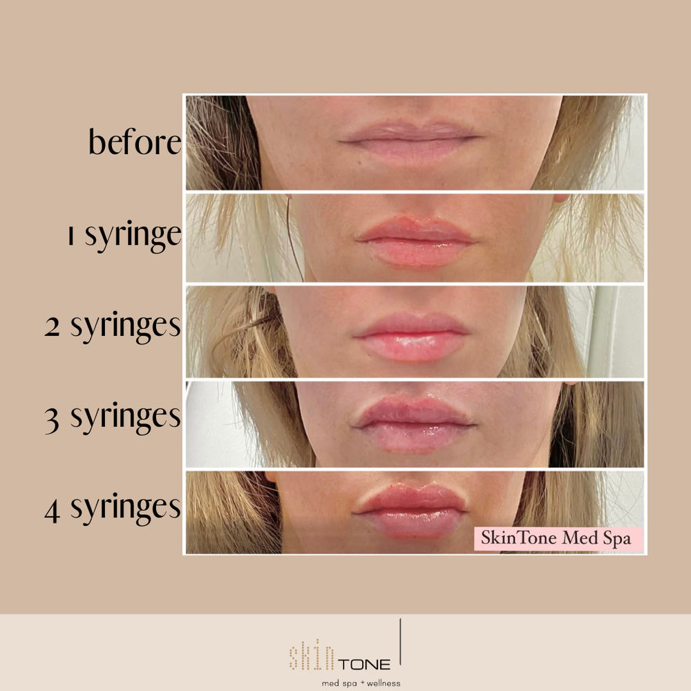 Juvederm Fillers — Skin Tone Med Spa