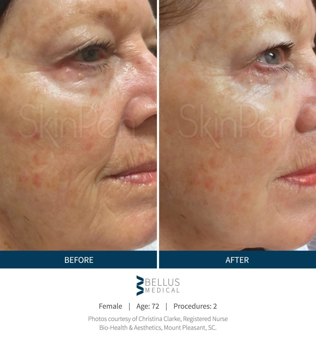 before-after-skin-pen-maine-laser-clinic.com_-e1540396145335.jpg